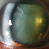 Oog met cataract of staar (vertroebeling van de lens)