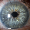 Foto van een oog dat een iriscerclage onderging