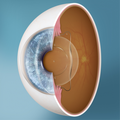 ICL in oog vooraanzicht