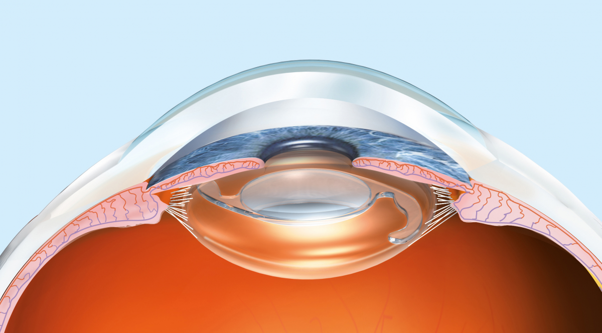 Implantlens In Kapsel