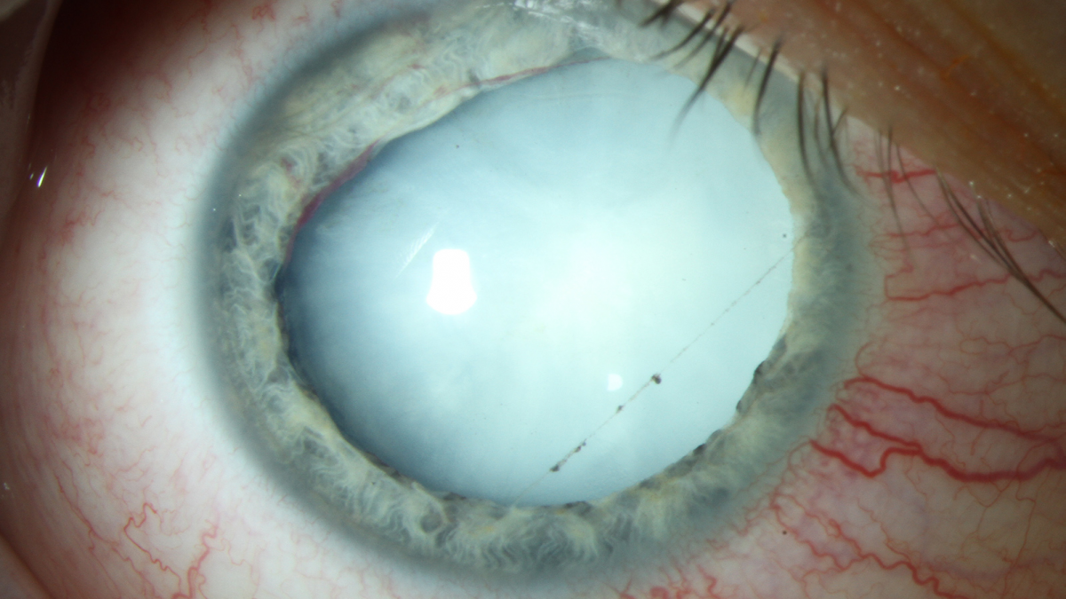 Cataract of vertroebelde ooglens