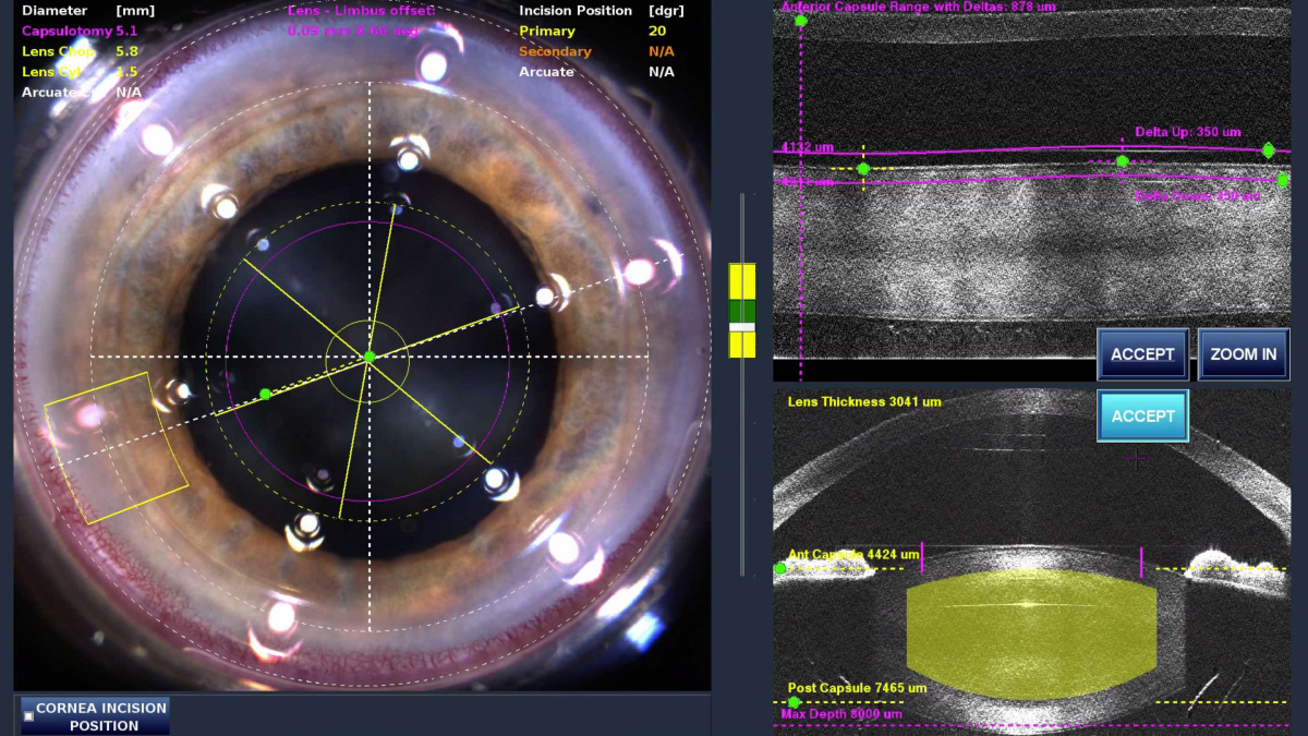 Header Laser Cataract