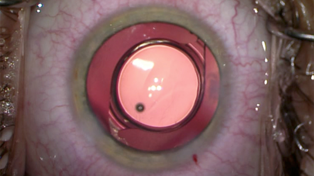 Een monofocale implantlens in het oog na een cataractoperatie