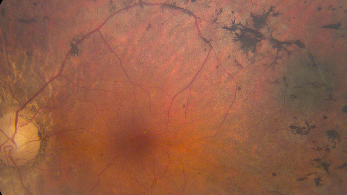 Netvliesfoto van retinitis pigmentosa