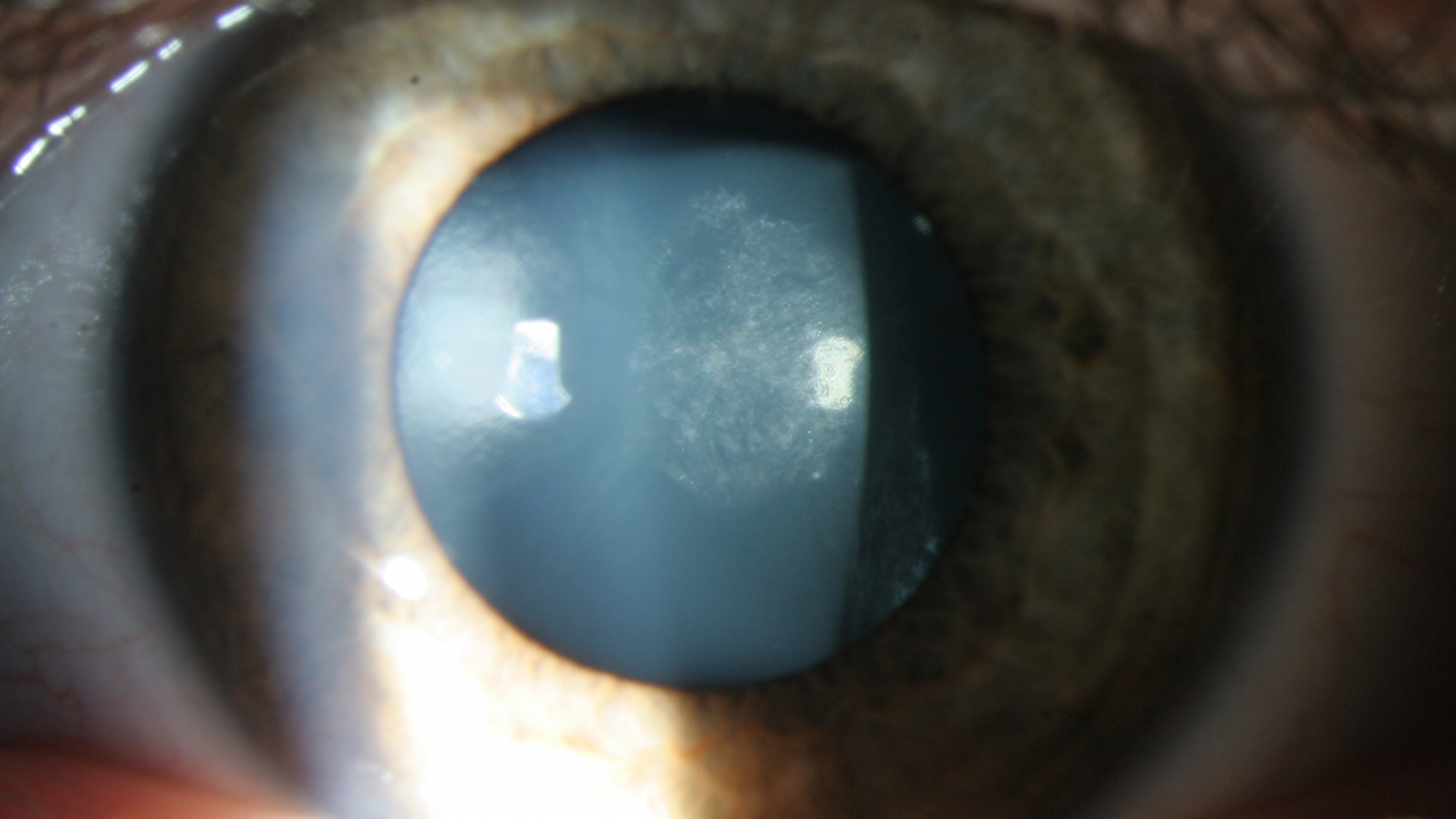 Oog met subcapsularis posterior cataract