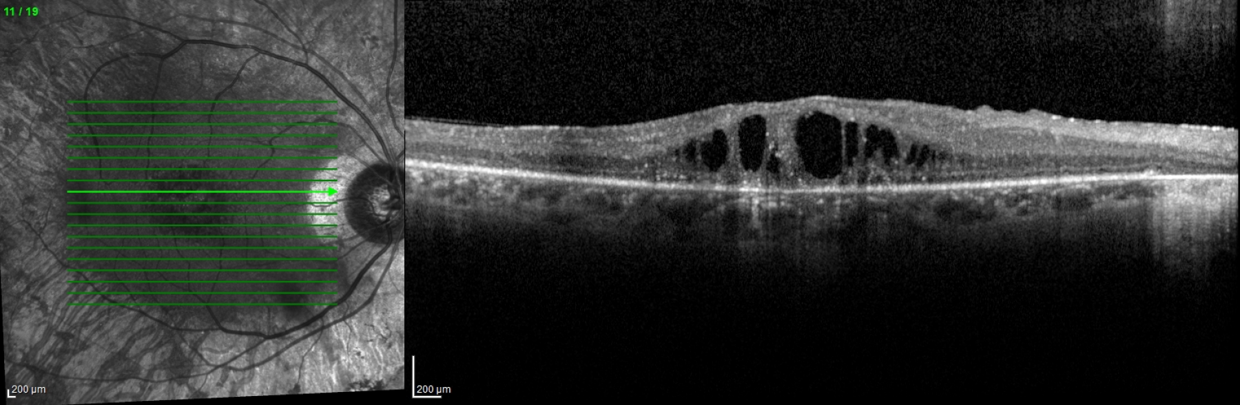 Netvliesscan (OCT) van een oog met maculair oedeem