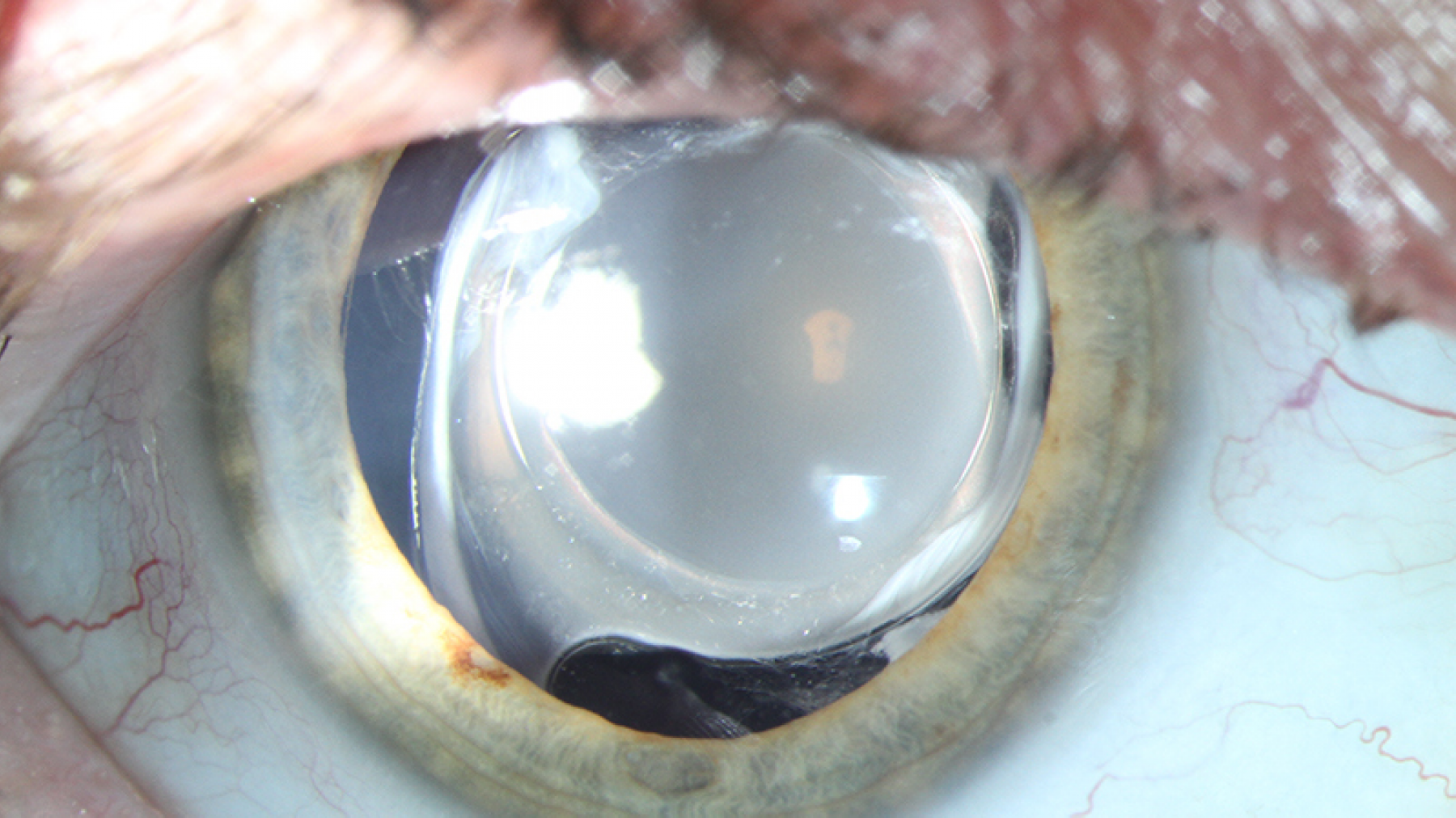 Vertroebelde Oculentis implantlens