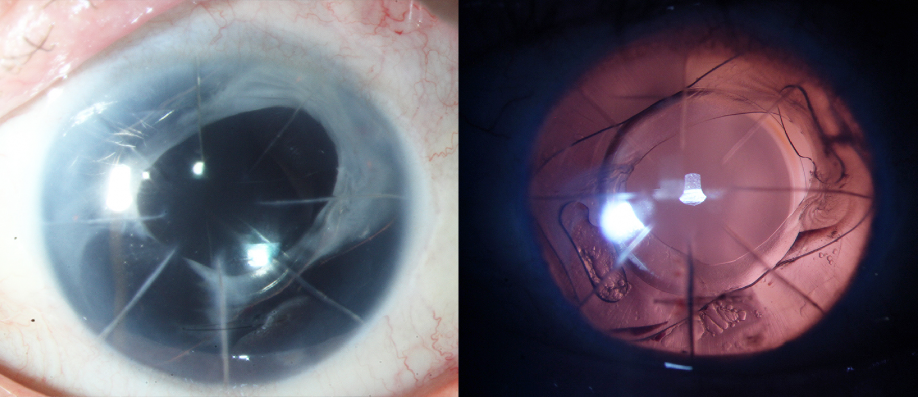 Foto's voor de ingreep met ArtificialIris